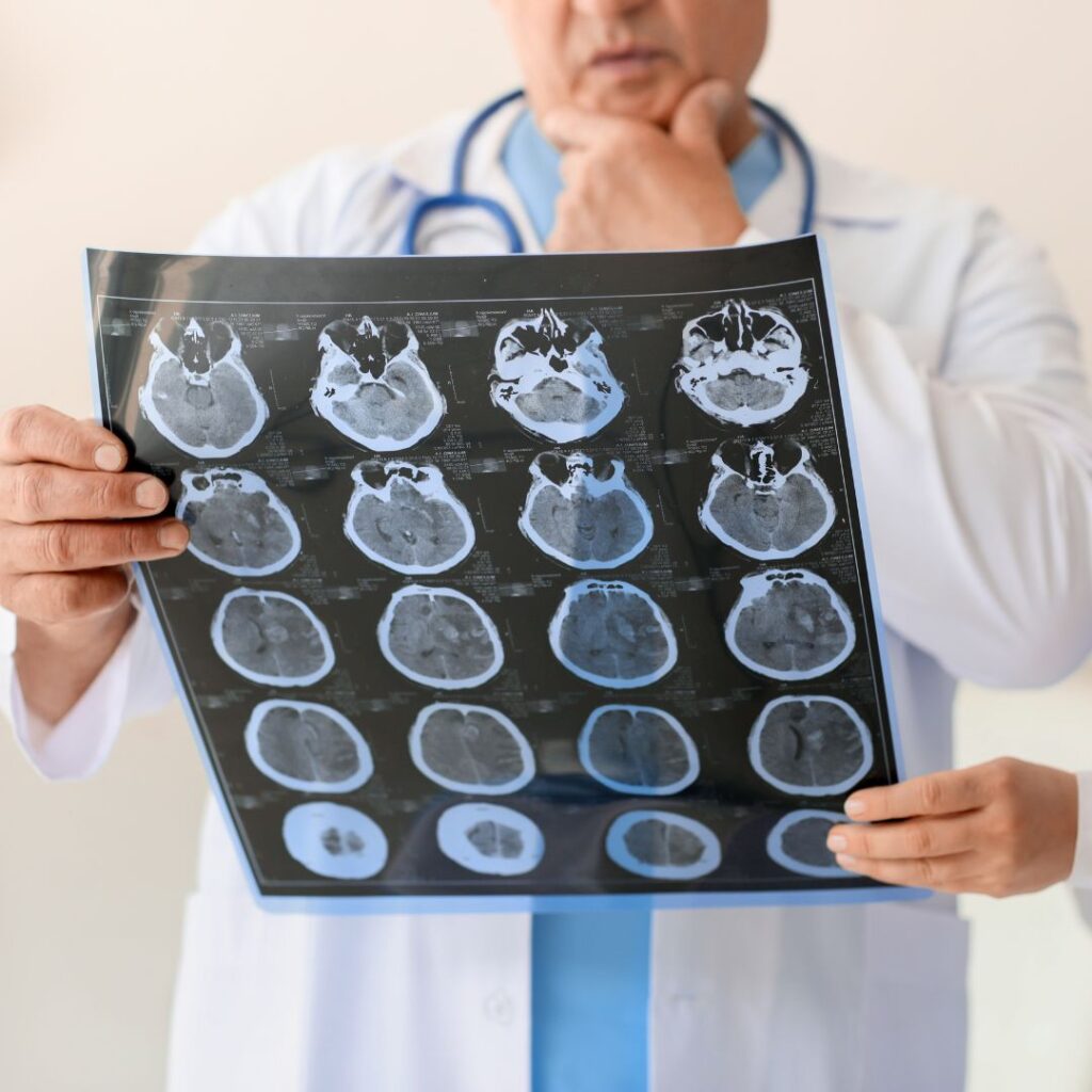 Une étude sur la détectin précose d'Alzheimer par le sommeil